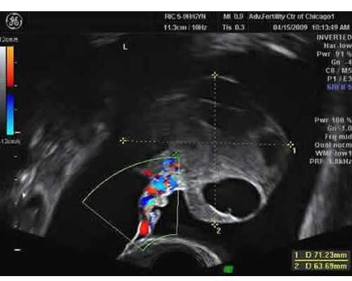 试管婴儿是否健康？？