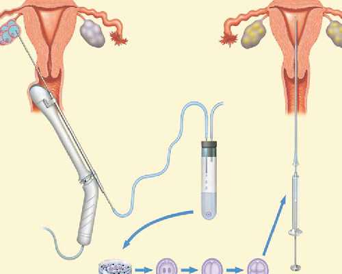 女性慢性iga遗传肾炎可以做三代试管婴儿吗？