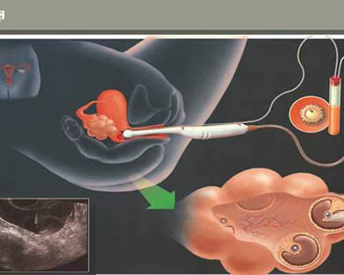 请问试管婴儿移植后几天能着床